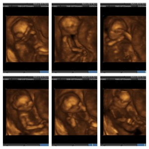 Maggie3D ultrasound