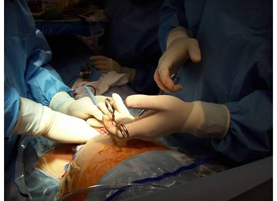 SurgicalBirth1