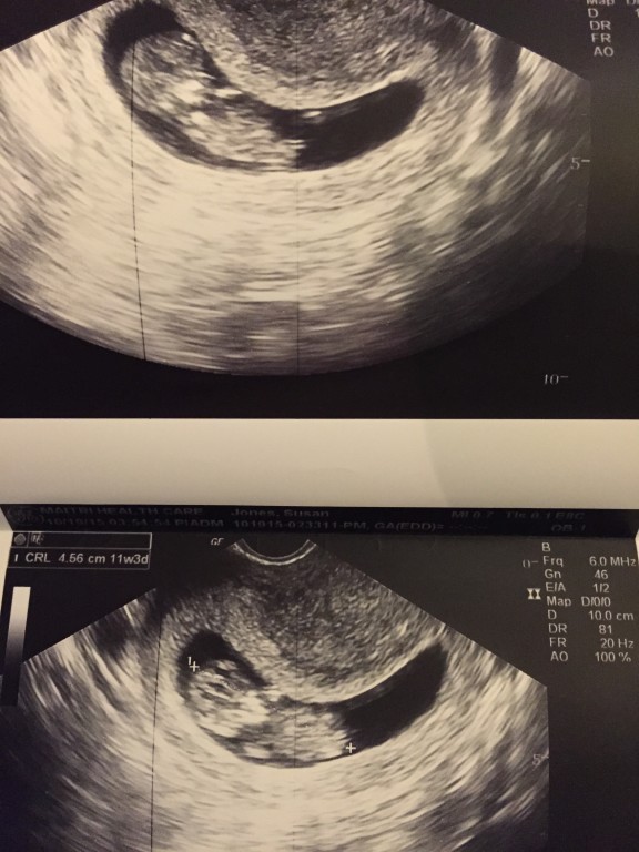 The Apprehensive 11 weeks. My journey through pregnancy after (multiple) miscarriages.