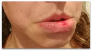 Fat lips are common mom injuries.