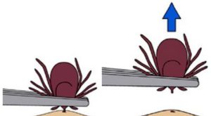 Removal technique for ticks