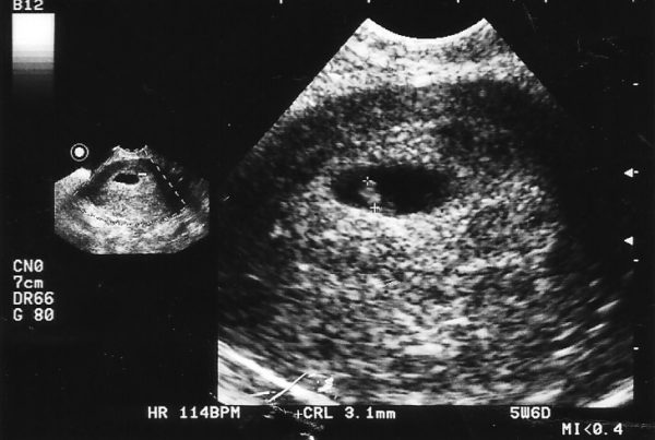 miscarriage, pregnancy loss, grief, rainbow baby