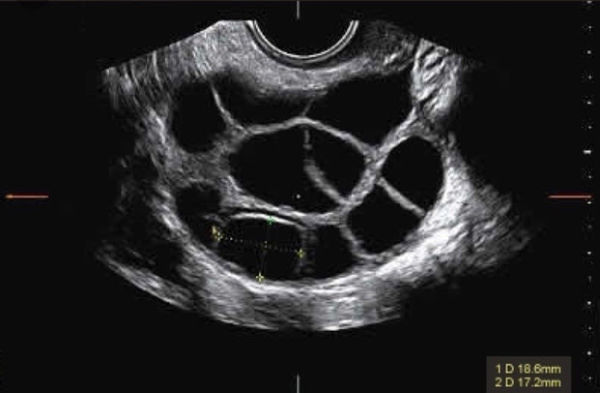 Follicular Ultrasound