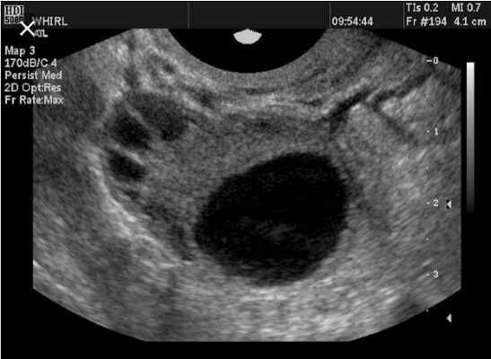 Follicular Ultrasound