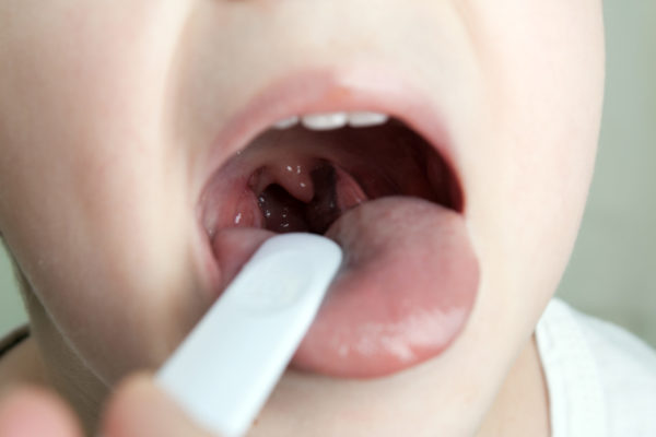 Image of someone with sore throat whose mouth is open with white tongue depressor