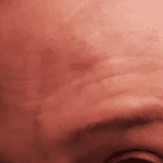 My Love:Hate Relationship with My Appearance or Me and My Scar pint