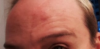 My Love/Hate Relationship with My Appearance or Me and My Scar my scar