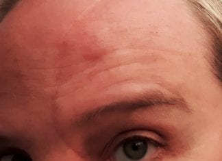 My Love/Hate Relationship with My Appearance or Me and My Scar my scar