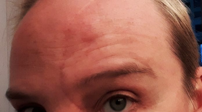 My Love/Hate Relationship with My Appearance or Me and My Scar my scar