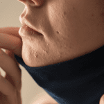 Treating my maskne and other skincare tips for moms featured