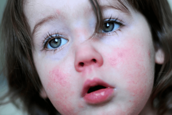 close up face of a feverish child with flushed cheeks