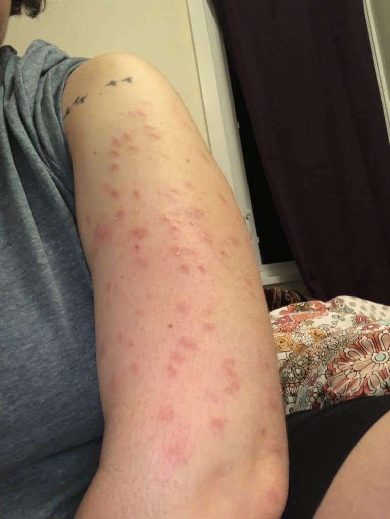 an example of the wounds caused by skin picking disorder- the arm is pale with some darker pink areas of irritation.